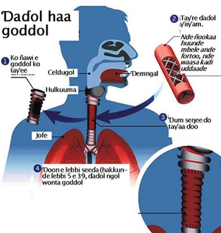Jokkere goddol. Natal Hopital Avicenne (AP-HP).