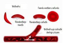 WAFRU (DRÉPANOCYTOSE)